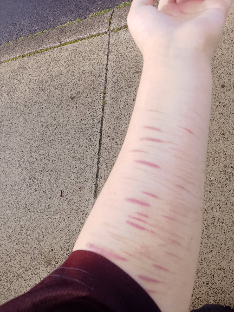 glitterpups494's tweet photo. Normalize going out with sh scars showing, fuck u whiny bitches I'm not covering them for ur ass #shedtwt #slicetwt #shtwt #SHtwt #slice #SH #sh #selfharm #SelfHarm #slittwt #slit #flugofshedtwt https://t.co/1EuVd27zve