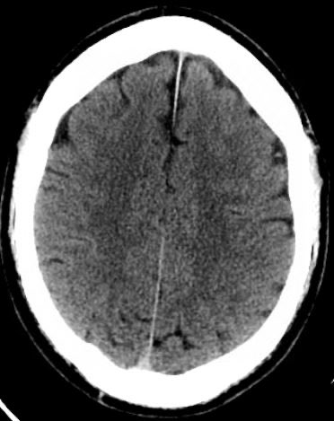 ERxICU_yakkun's tweet photo. これは発症から時間がたってるけど、SAHのCT

わからない事もあるのよ https://t.co/k2bERTjUGJ