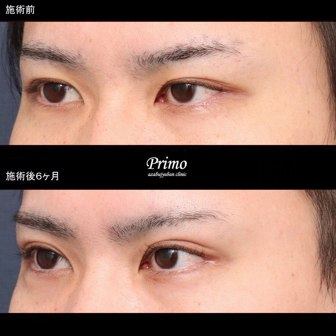 primoclinic's tweet photo. 眼瞼下垂手術＋下眼瞼拡大術＋目尻切開を行いました。

手術後は眼瞼下垂手術によって目の開きを大きくし、二重の幅も少し広くしました。

目尻切開+下眼瞼拡大術によって目が切れ長な方向に大きくなりました。
 
・費用
眼瞼下垂手術　　　　　￥660,000
下眼瞼拡大術　　　　　￥440,000
目尻切開術　　　　　　￥275,000
 
・リスク・副作用
腫れ、内出血、瞼の違和感、傷跡
睫毛側皮膚の知覚低下
瞼の形態の変化、顔の印象の変化
ドライアイ
三白眼、逆さまつ毛

プリモ麻布十番クリニック