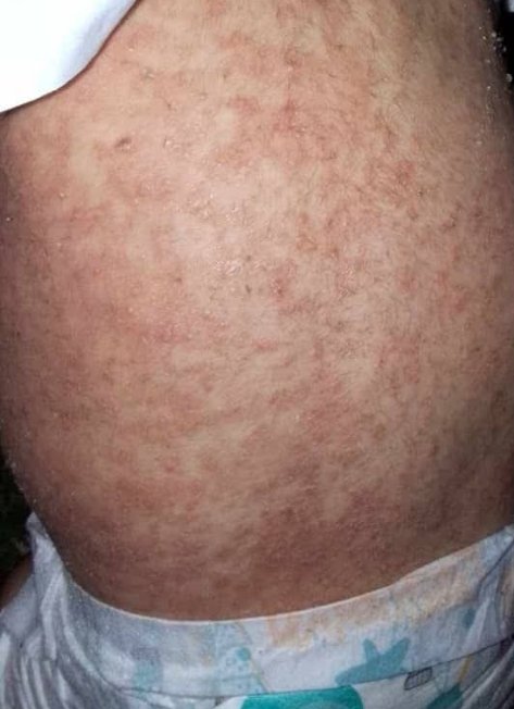 DalulainGaza's tweet photo. My child has a contagious skin rash and needs treatment. Please help me. 

https://t.co/MfwQOKJDkb https://t.co/viCQteRPH2