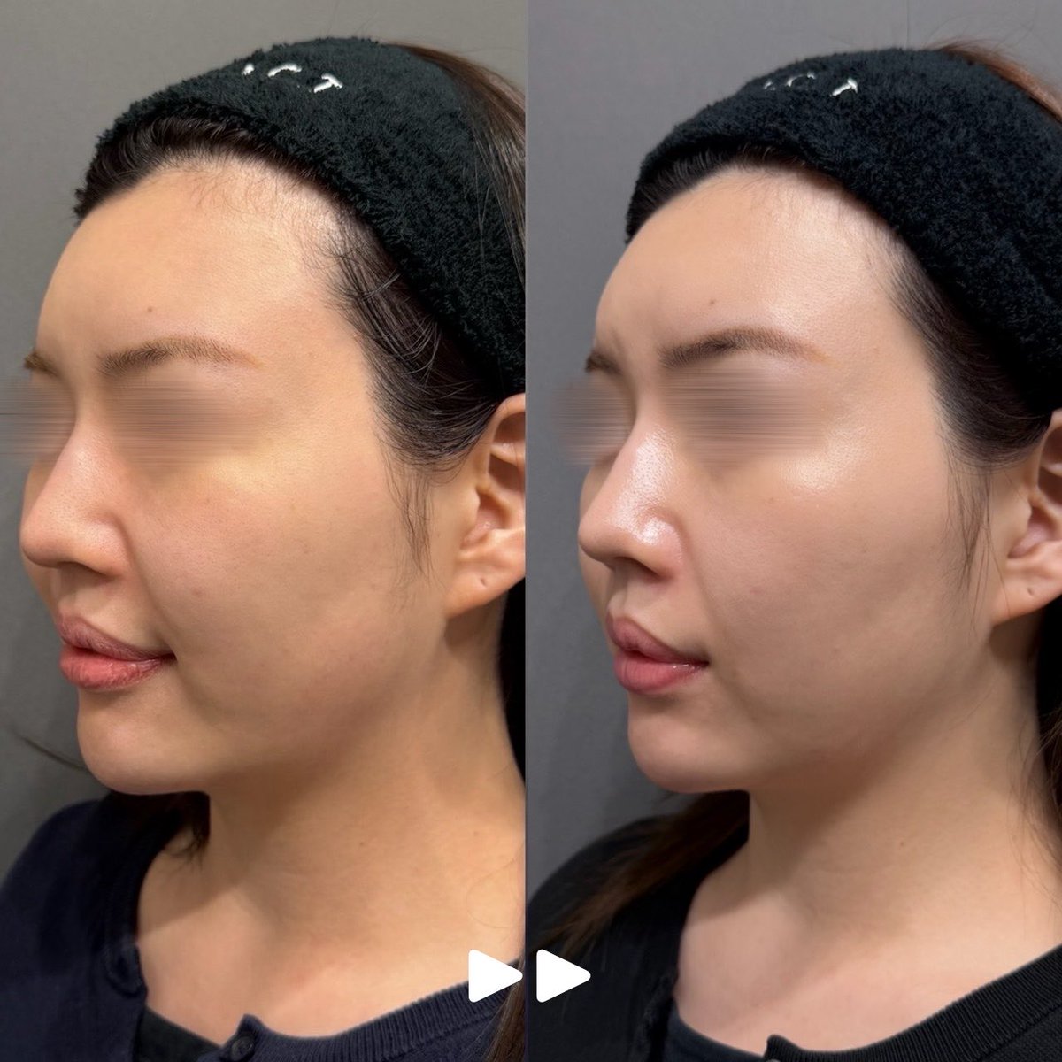 SELECTCLINIC's tweet photo. ご紹介ありがとうございます✨️

🉐ソフウェーブ導入キャンペーン中🉐

￥29,800〜施術可能です✍🏻

📍銀座院限定

皆様のご相談お待ちしております🙌🏻 https://t.co/YxkoLfbq2j