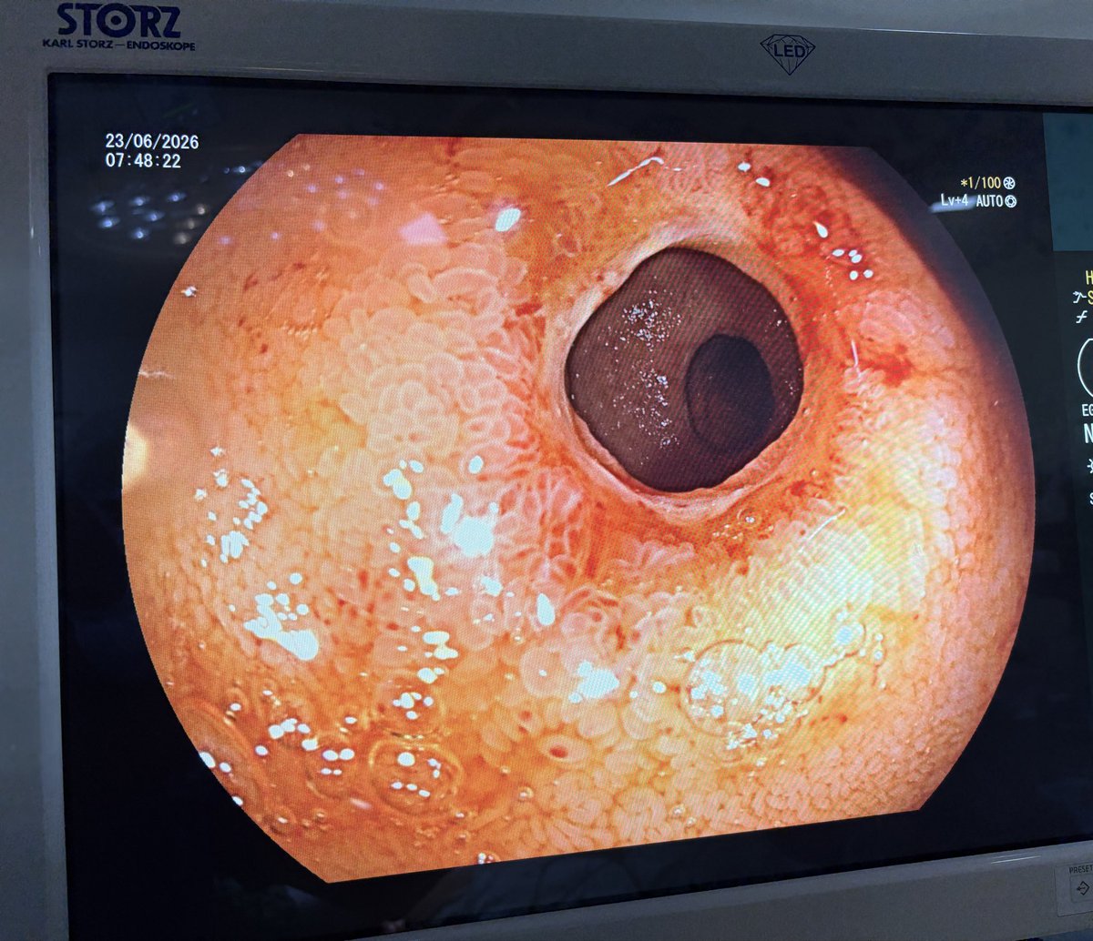 dradjoshi's tweet photo. Hidden deep within the small bowel are often the answers to unexplained anemia. With double ballon enteroscopy, we can uncover elusive lesions missed by conventional investigations.

#Gastroenterology #SmallBowelEndoscopy #IronDeficiencyAnemia #MedTwitter https://t.co/Fn7cHVRCOe