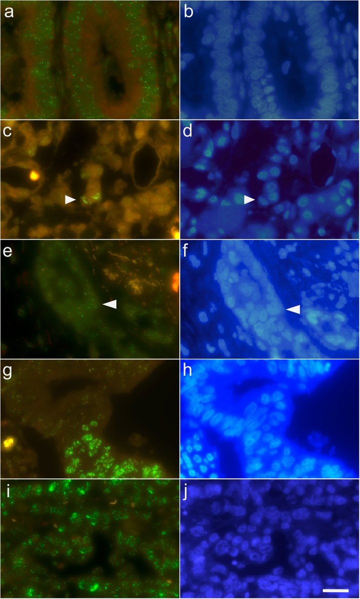 BioMedCentral's tweet photo. A study in #BMCCancer finds that MYC gene amplification in gastric and gastroesophageal junction cancers is common, highly variable within tumors, and associated with more advanced disease, poorer survival, and reduced response to chemotherapy.
https://t.co/Xdypyp9qbv https://t.co/YjdnJomKAn
