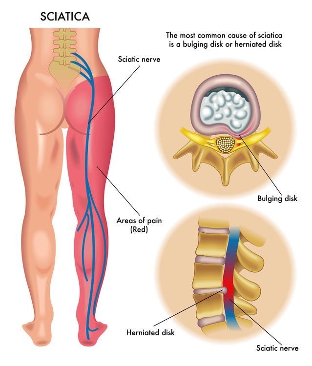 TrackYourHeart's tweet photo. The most common cause of sciatica in adults is:
A. Piriformis syndrome
B. Lumbar disc herniation
C. Lumbar canal stenosis
D. Sacroiliitis https://t.co/Lm4NMg5zG8