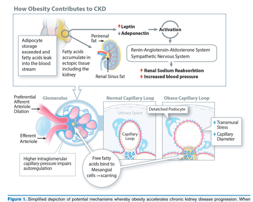 isn_india's tweet photo. 2/🔴 Obesity is a chronic relapsing disease and is the MC risk factor for CKD, affects >40% adults, >20% kids in the US. 

Adipokine imbalance, RAAS &amp; sympathetic activation, sodium retention, glomerular hyperfiltration &amp; lipotoxicity all drive CKD progression.
#TheWeeklyNephron https://t.co/OaKOGd47Z3