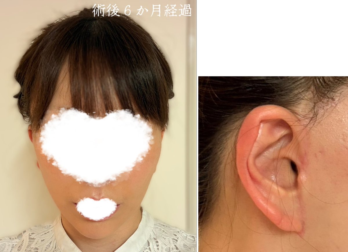 mofugold1688's tweet photo. プラスアップリフトの術後６か月です✨️
耳元はまだ少し赤みがありますが皮膚感覚や固さはほぼ元に戻り、６か月経ってもフェイスラインは自然に引き上がったままでとても満足しています☺️✨️
ノーマルカメラで撮影📸 https://t.co/4A2D7XYeAB