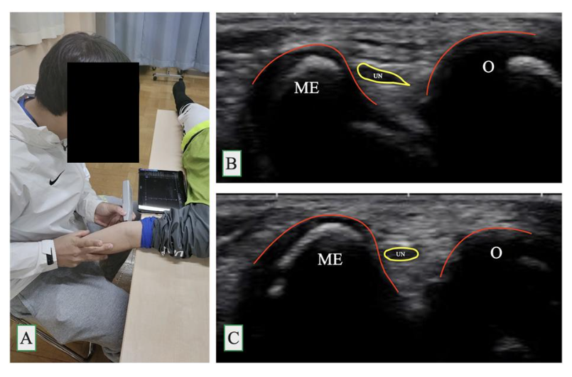 jbjs's tweet photo. "Marked Increase in Anterior Ulnar Nerve Displacement at β₯90Β° of Elbow Flexion in Healthy Children" by Nakagawa et al.
Read the full article π https://t.co/NqHFXltOkO
#JBJS https://t.co/ukEvU83lN4