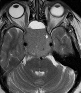 aggarwal1811's tweet photo. Case 4- 55y female with headache and blurring of vision in both eyes- What is your diagnosis? #Neuroradiology #NeuroRad #FOAMRad #RadEd #CaseOfTheDay https://t.co/uLIvwT9VNc
