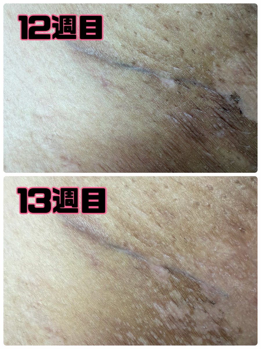 peko_40's tweet photo. 今週の傷跡📸13週目

中々目立たなくなるまでにはいかないけど全然綺麗になってきたんじゃないかなー？

放射線の跡で色がすごいけどねー🤣
皮むけも脇のとこもなかなかすごくないー？？😵

写真の写りは割と綺麗けど実物はもっとまがまがしい色してる!!笑

#乳がん #傷跡 #術後経過 https://t.co/vJ0eK7s72k