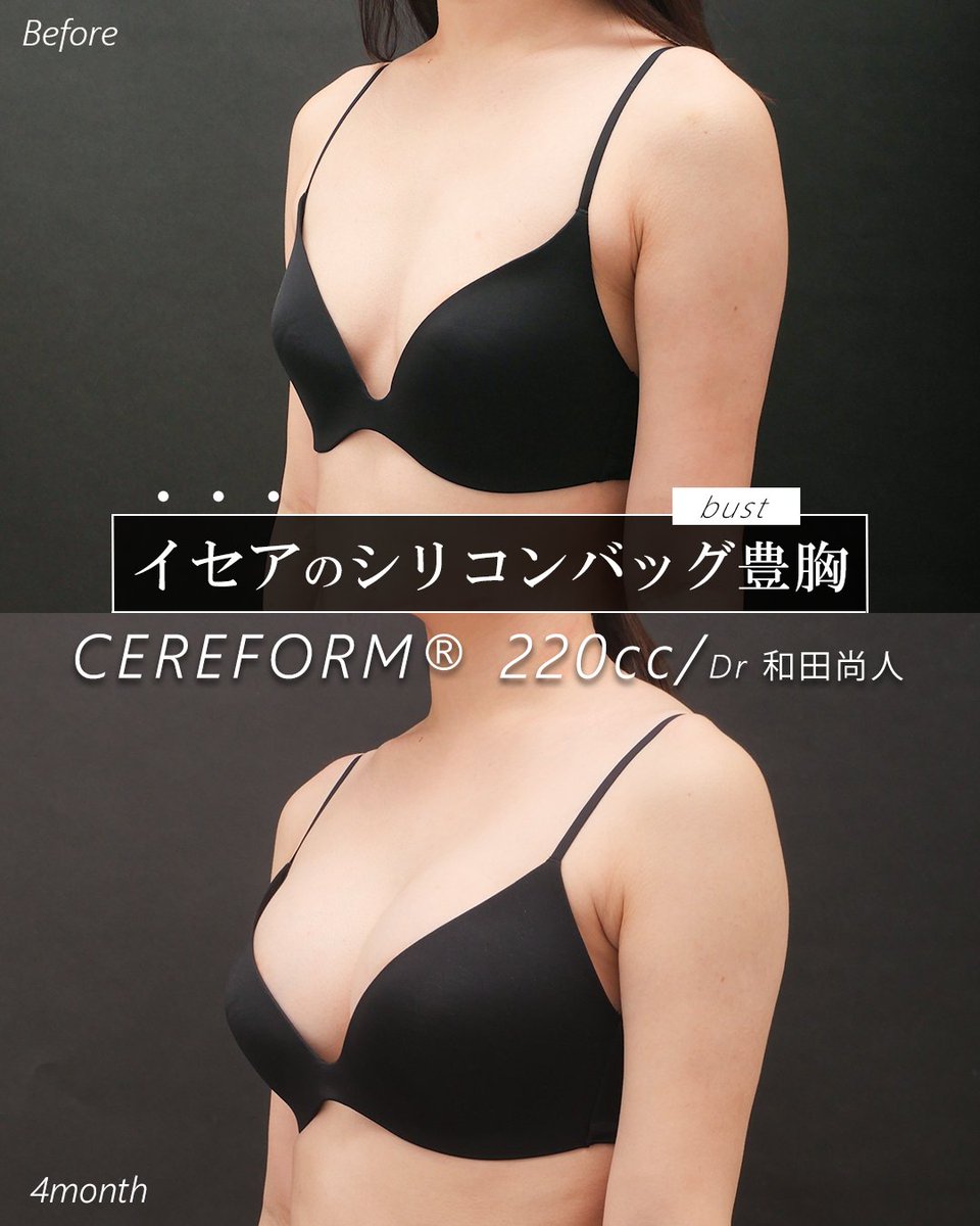 wada_isea's tweet photo. 「2カップは大きくしたい。でも、豊胸したとは気づかれたくない。」

身長162cm・BMI20.2の患者様。「しっかりサイズアップしたいけれど、自然に仕上げたい」というご希望でした。Miniでは物足りず、Demiでは張り出しが強いため、体型に合うセレフォーム RM220ccを選択。術後6か月で約2カップアップ。 https://t.co/gTzkxUtIw9