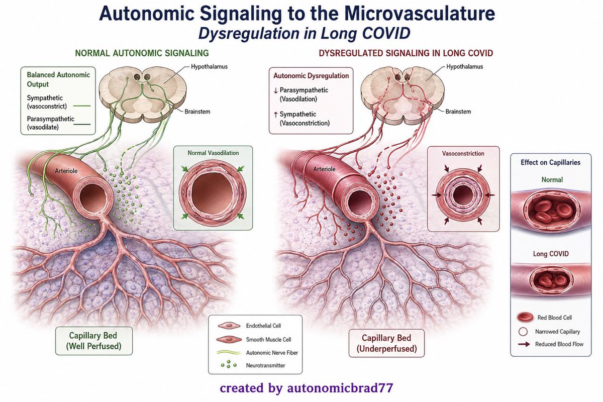 AutonomicBrad77's tweet photo. The actual mechanism of Post Exertional Malaise (PEM) is related to this concept of Dysregulated Autonomic Signaling to the Microvasculature causing narrowing of the capillaries. This occurs in different locations at different levels of dysfunction for different patients which could explain the difference in Patient experiences. This is where the Researchers fail us… #LongCovid #pwME #POTS #Dysautonomia #pwLC
