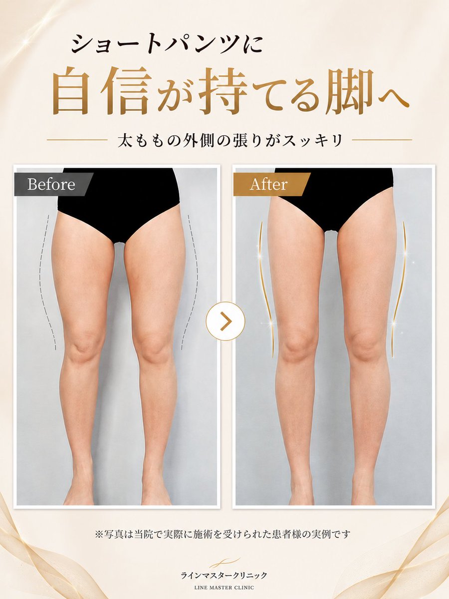 line_masterjp's tweet photo. 【360度どこから見ても美しい太もも大容量脂肪吸引】 

＃ラインマスタークリニック の ＃太もも脂肪吸引で、 隙間のあるスラリと長い「理想の美脚ライン」へ✨ ”ただ細くする”のではなく、お尻の位置を高く、脚全体を長く魅せる 「自信の持てる #ストレート美脚」へ！

まずはLINEでご相談を☺️ https://t.co/k0eBExd63d