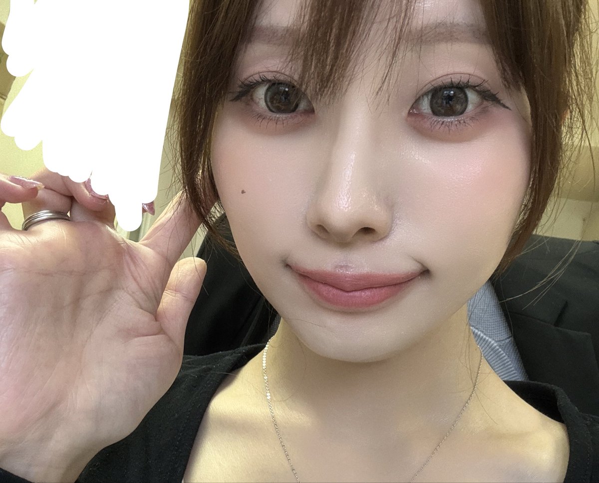 2k8vi's tweet photo. ハイボムの人中3点経過レポ✏️dt24日目
外側人中の感覚は少しだけ戻ってきた！もらった軟膏はずっと塗り続けて傷跡も少しずつ改善中🙆🏻‍♀️審美的な面でも大満足🥹✨リップメイクが楽しい💄💭動かしにくさはまだあるけど日常生活に支障はなし！
@hivompsJP 
#ハイボム美容外科 https://t.co/9iAvReD4TI