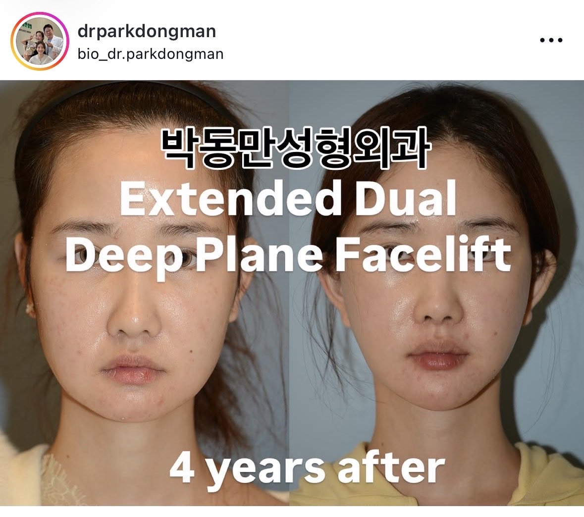 ps_0328's tweet photo. 切開リフト、パクドンマン先生が術後1年~7年の症例写真をインスタに載せてて参考になる
ただのディーププレーンではなくデュアルプレーンというのも個人的にはポイント https://t.co/thpRPLTeCW