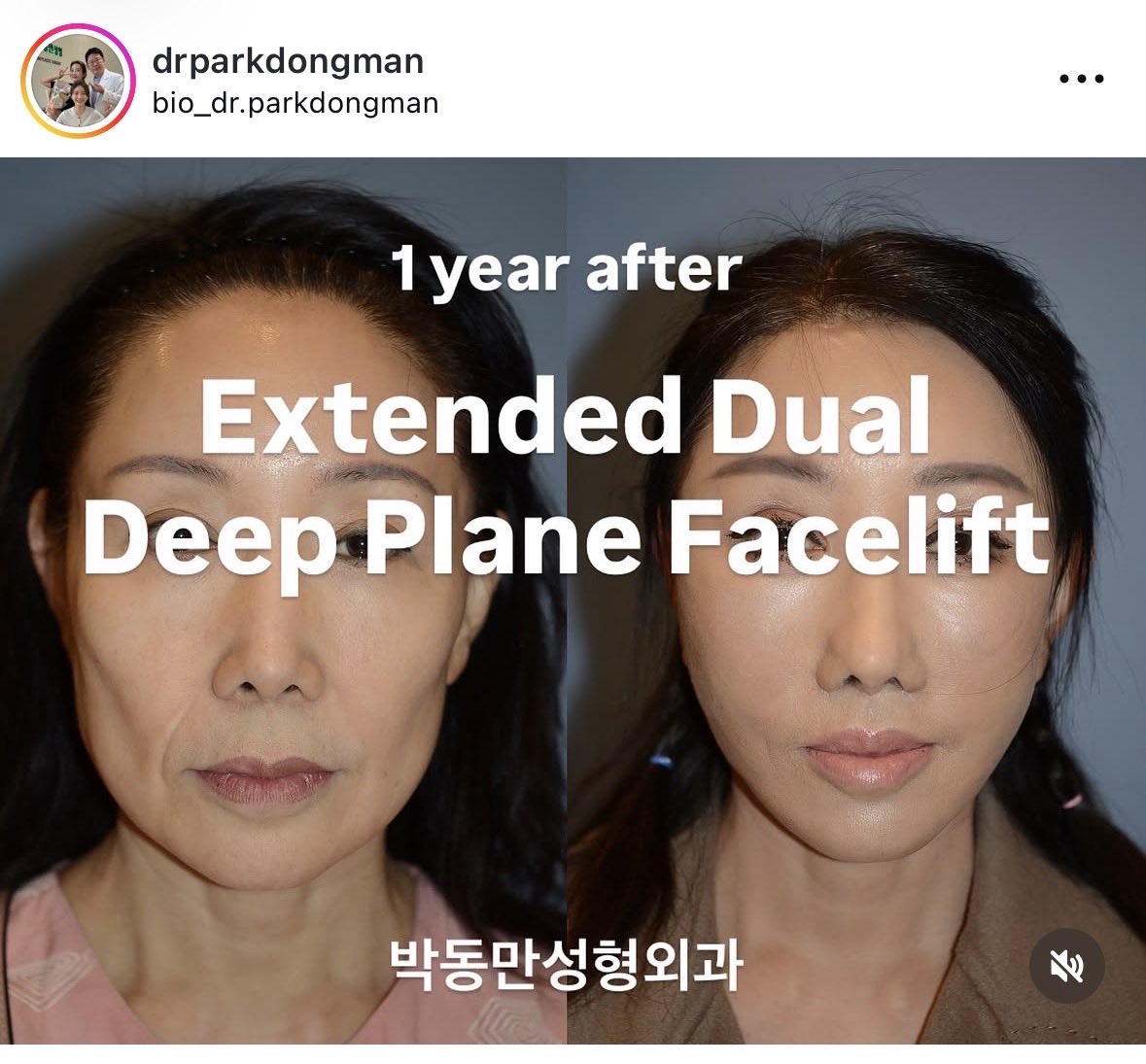 ps_0328's tweet photo. 切開リフト、パクドンマン先生が術後1年~7年の症例写真をインスタに載せてて参考になる
ただのディーププレーンではなくデュアルプレーンというのも個人的にはポイント https://t.co/thpRPLTeCW