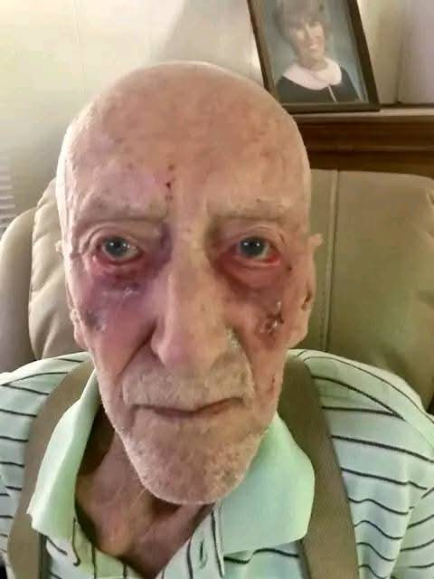 Ivermectinkart's tweet photo. IVERMECTIN Topical Cream Testimonial - 88 year old Alberta farmer with  skin Cancer has 4 tubes of Ivermectin paste sent to him by his son

More and more Topical Ivermectin testimonials are starting to come in...

88 year old farmer in Alberta was diagnosed with skin cancer 

His son sent him 4 tubes of Ivermectin paste.

"He called this morning to report that after a month, he has used three tubes and has applied three times a day. The cancer has cleared up..."

Every type of skin cancer can be treated with Topical Ivermectin: basal cell carcinoma, squamous cell carcinoma and yes, even melanoma.

You can start to see a response visually fairly quickly...within weeks!