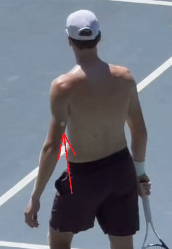 jmgmoron's tweet photo. Sinner ha sido visto estos días en Montecarlo usando este dispositivo, que ha despertado el interés de más de uno, preguntándose qué es eso.

Es algo muy concreto.

El italiano parece estar usando un sensor de glucosa, un dispositivo cada vez más utilizado en el deporte de élite para controlar cómo responde el cuerpo al esfuerzo, la alimentación, el calor y la recuperación.

Este dispositivo no mide directamente la sangre en cada instante, sino la glucosa presente en el líquido intersticial, bajo la piel, y permite ver tendencias durante el día: subidas tras comer, caídas durante el esfuerzo, respuestas al calor, al estrés o a la falta de recuperación.

Tras el episodio sufrido en París, donde padeció síntomas compatibles con un fuerte golpe de calor y un bajón físico importante, el italiano se sometió a estudios médicos durante dos semanas en Italia para analizar diferentes parámetros y entender qué ocurrió.

Es lógico pensar que los médicos le han querido medir la glucosa en diferentes aspectos, como aquí el caso de entrenar bajo el calor, para seguir haciéndole estudios y entender por qué le pasa lo que le pasa a grandes esfuerzos en días de mucho calor y humedad.