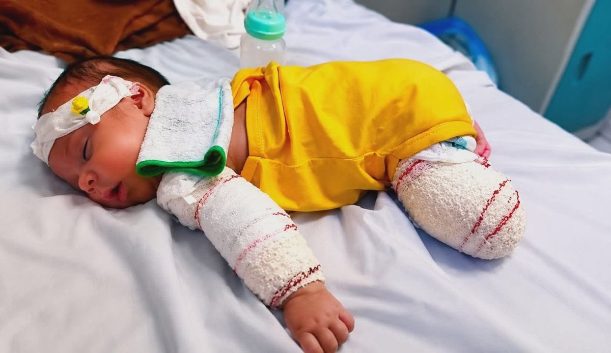 drkerem's tweet photo. Muhammed ElHatib, tam bugün kırkı çıktı. İşgal güçlerinin saldırısı sonrası yaralandı, kırk günde tam altı büyük ameliyat geçirdi. Tedavisi için dışarı çıkışına izin verilmedi. Şu minik bebeğin kesilen kollarında bacaklarında görün dünyayı. Onun kırk günlük paramparça bedeni ile hayata tutunmasında görün direnişi. 
Rabbim ver Şifa’nı Muhammede 🤲❤️