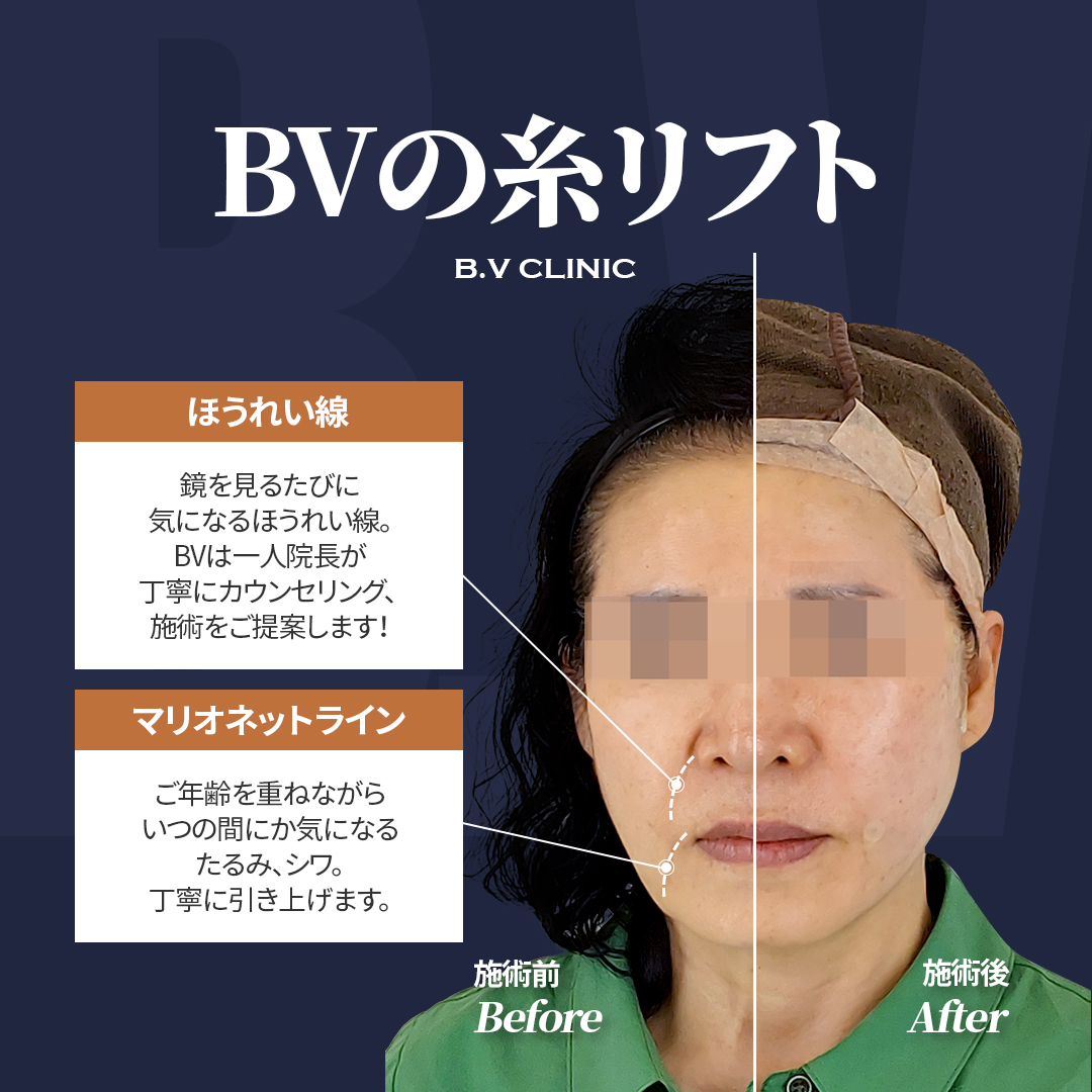 BVclinicjp's tweet photo. ご年齢を重ねながら気になる
ほうれい線、マリオネットライン💦

お顔のバランスを見ながら、
自然な引き上がりを目指した
オーダーメイド糸リフトをご提案します☺️

お気軽にお問い合わせください🙌

韓国糸リフトはBV💙
お問い合わせはこちら!     
https://t.co/f2nIlfa6ht 

#カンナム  #渡韓情報 https://t.co/LUbYB5AnOB