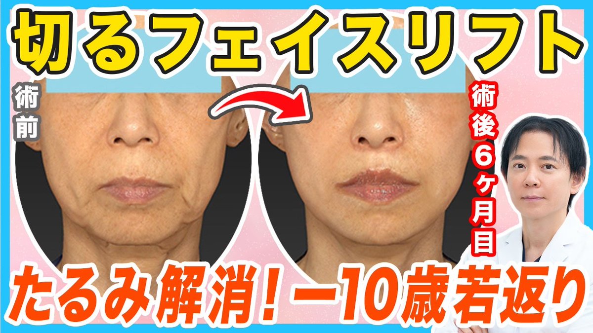 RacleCL's tweet photo. 【切開リフト】フェイスリフトで顔のたるみが解消した症例を解説【若返り】
https://t.co/bwmr2waHXN
「フェイスリフトで本当に変わるの？」そんな疑問にお答えする実際のビフォーアフター6症例をご紹介👨🏻‍⚕️✨変化のポイントを動画でぜひご確認ください🎥✨ https://t.co/aQkjIZenPm