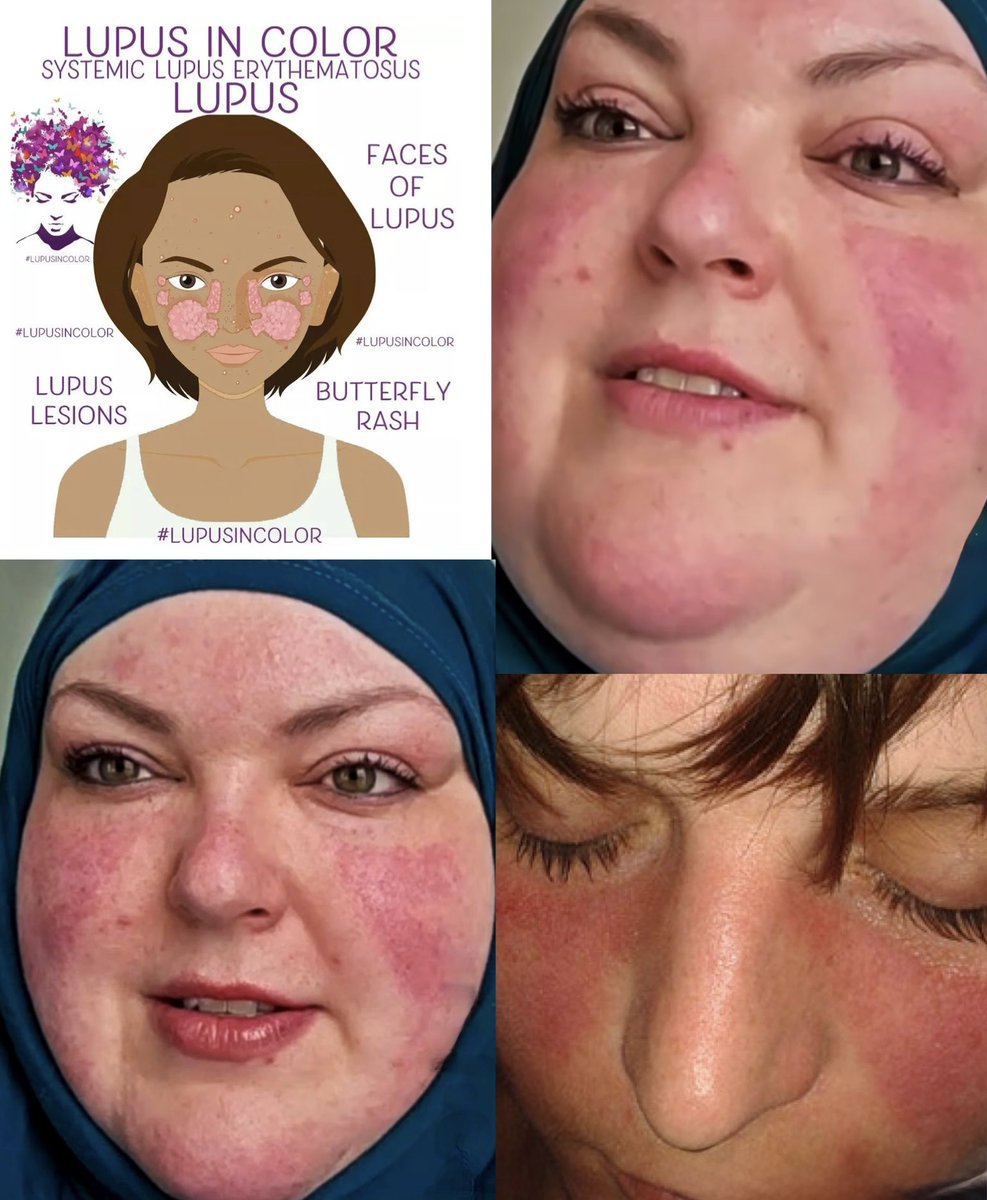 tatvonb's tweet photo. I’ve been reading about butterfly rashes, which typically appear across the cheeks and bridge of the nose and are often linked to Systemic Lupus Erythematosus. Looking at Buffalo, I’m not convinced it’s rosacea. Obviously, I’m not diagnosing her, but I’m curious what everyone else thinks. Does it look like something different to you? 
#foodiebeauty