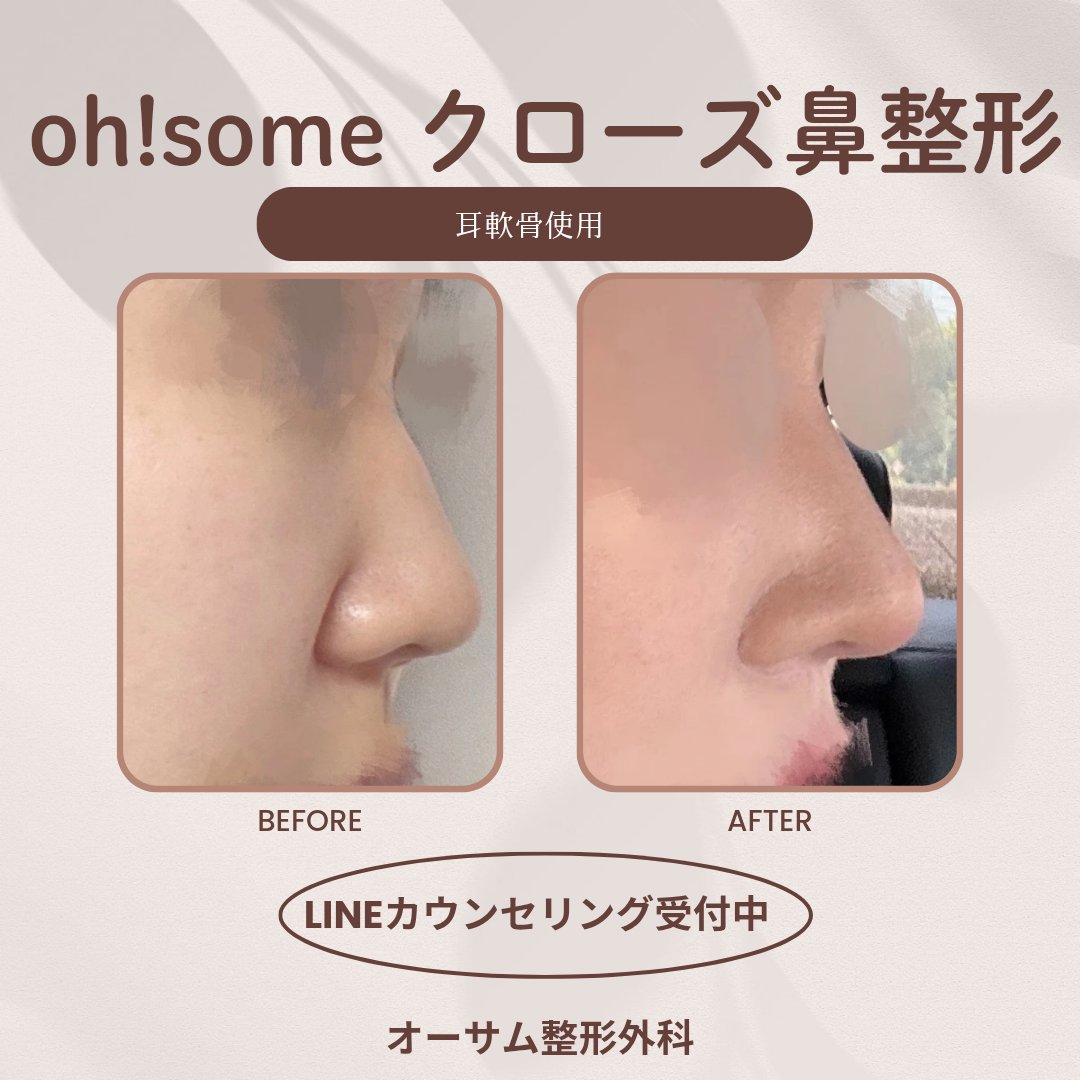 Ohsome_ps's tweet photo. 鼻整形考えてる方朗報です🎉

​オーサム大人気の鼻整形イベントが、ついに【399万w】でカムバック❗
肋軟骨使用は【629万w】👀
​
物価上昇無視の逆行🚄
部分モニターで今だけの特別価格で😽

あなたの適応は❓
​RTしてLINEで相談🏃‍♀️💨
📩  https://t.co/8Gq5dAAg8X

​ #鼻整形 #鼻先整形　#忘れ鼻 https://t.co/5PWoOA9Bv4