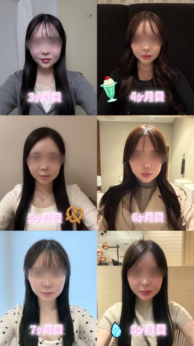 mi__01298's tweet photo. 載せるの遅くなっちゃった (っ ̫ ; ˘)💧
🇰🇷の @Reface_hs さんで両顎輪郭3点してから8ヶ月も経ってた😳
特に機能的なトラブルもなく腫れも落ち着いたよ🧁
ほうれい線とフェイスラインのたるみが気になるからたるみケア徐々にしなきゃ( ;´꒳`;)
 #両顎  #輪郭3点  #リフェイス   #リフェイス口腔外科 https://t.co/KGB6Wv3Zim