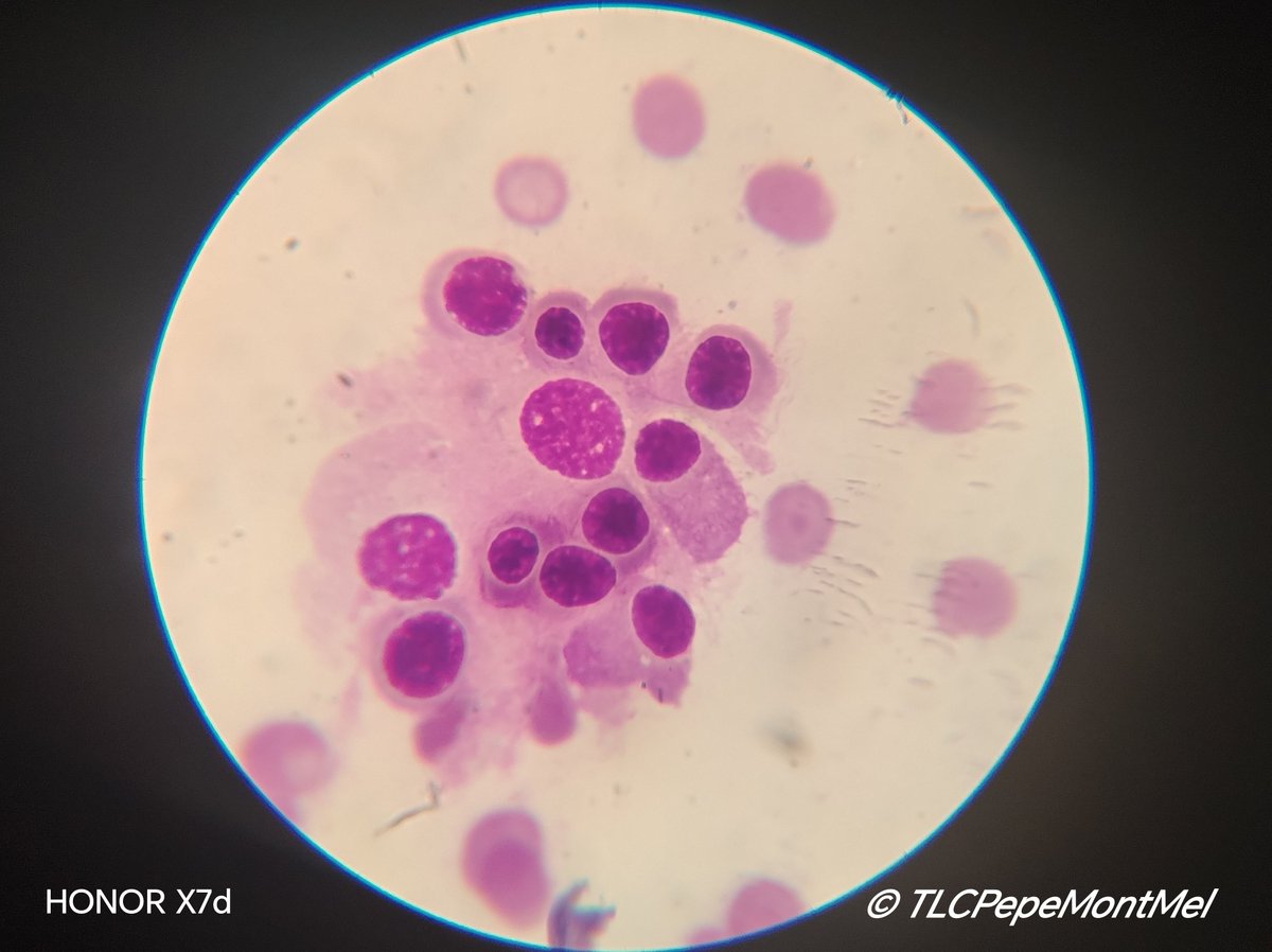 JMontMel's tweet photo. #ClinicalLaboratory #Hematology #Microscopy
Isla eritroblastica 🩸❤️ https://t.co/2XfEtJmEpP