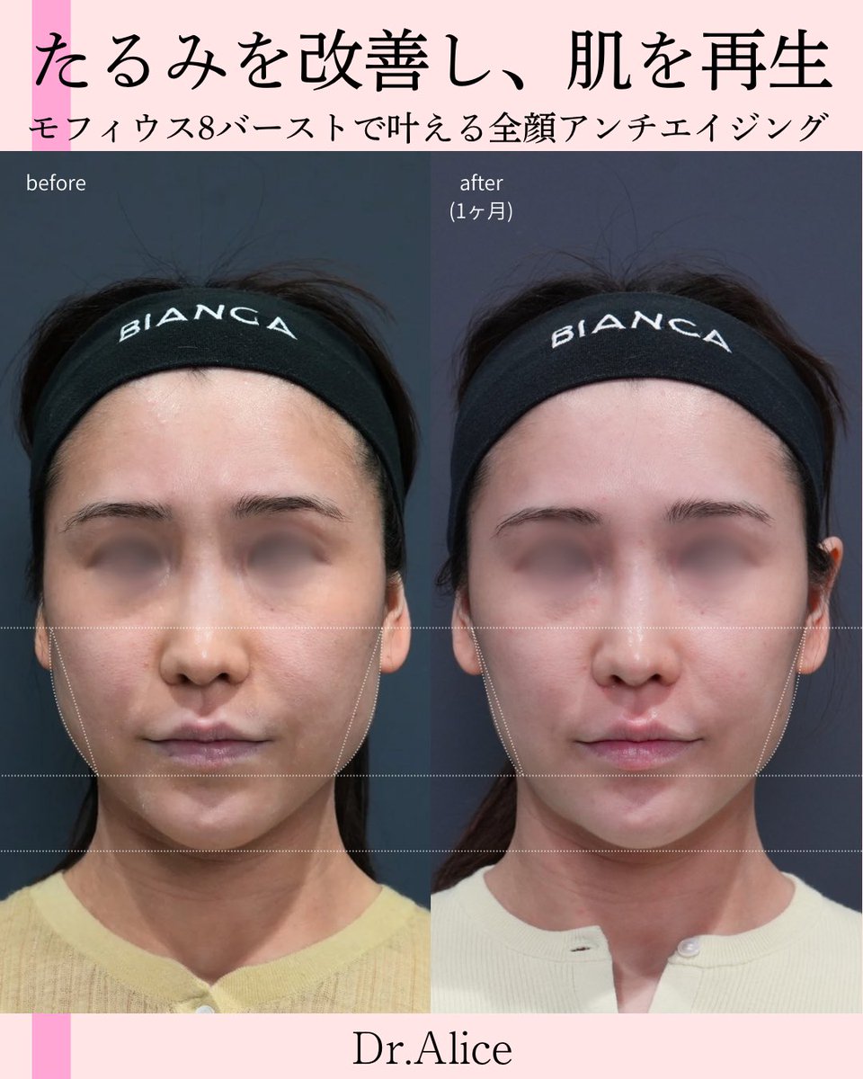 alice_time32's tweet photo. このお肌の変化、一回の施術だって信じられますか？
もちろんタイトニングも狙えます。

#たるみ治療 #たるみ毛穴  #肌質改善 #毛穴治療 #モフィウス8 #モフィウス8バースト #インモード
https://t.co/IREYyrbzWl https://t.co/FGXzUQ6Xgt