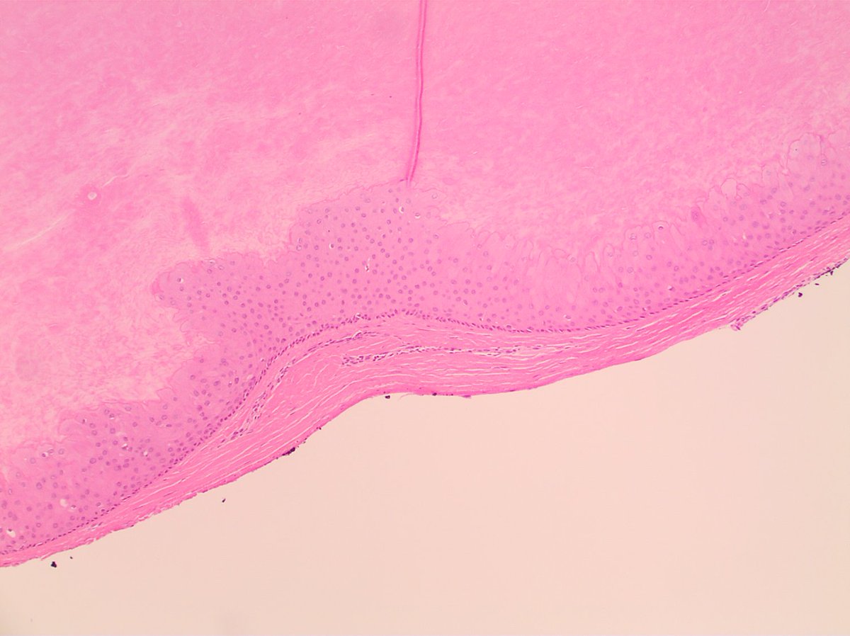 VHNguyenMD's tweet photo. Multiple pilar cysts in a teen with a family history.
#Easypeasy? Yes and No...
#PediPath #DermPath https://t.co/3E2y3GcyRb