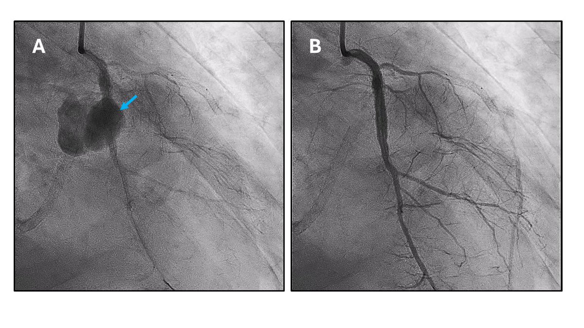 emilioblanco96's tweet photo. 🫀 Tratamiento percutáneo de seudoaneurisma micótico coronario tardío 

👉https://t.co/lyaNjRDHZc #recintervcardiol a través de @RevEspCardiol 

@Martahb5 @650Torres @RuizNodarJM @shci_sec https://t.co/Lst4eto9Uw