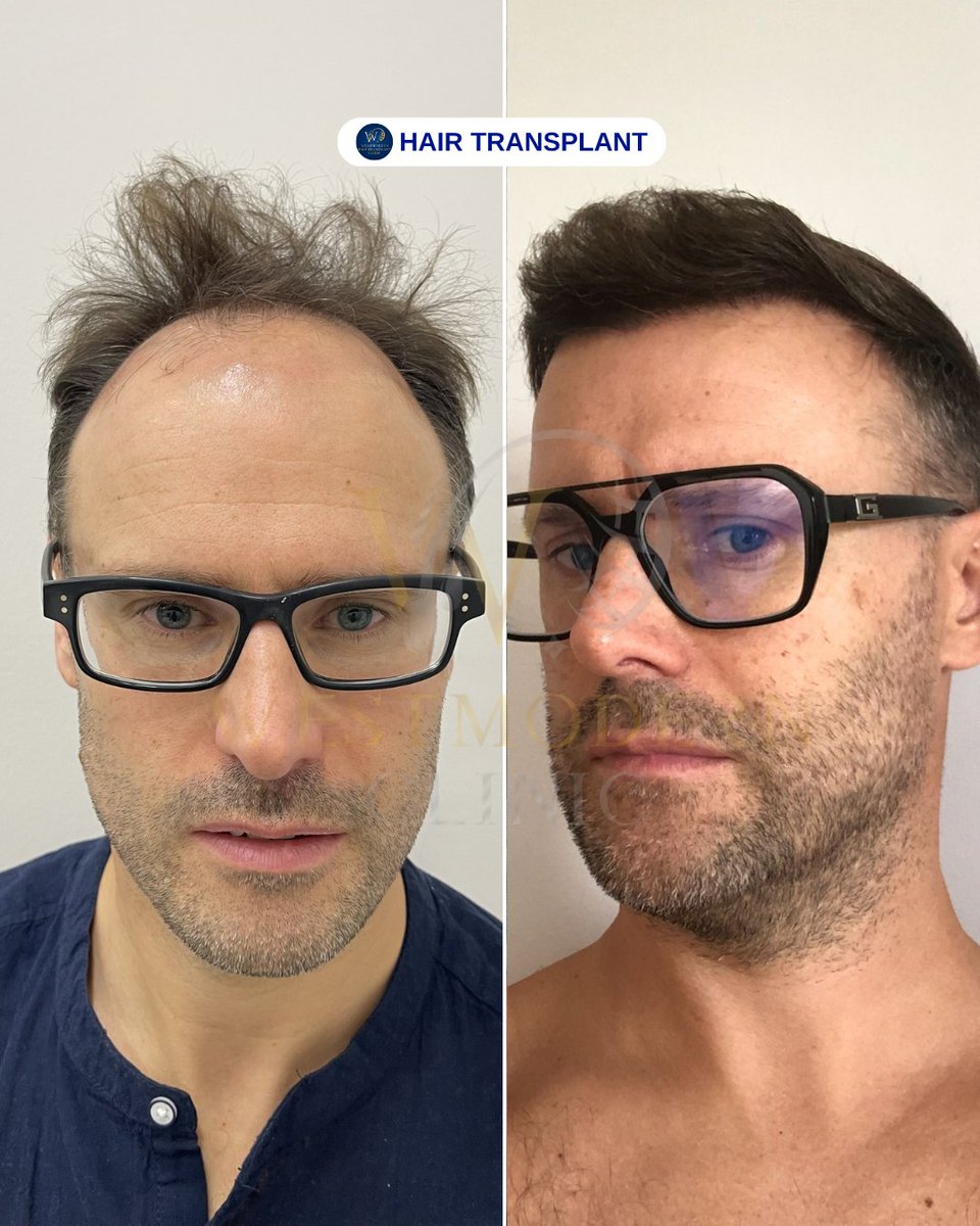 WestModernTR's tweet photo. “With West Modern Clinic, enjoy natural and stylish hair for every look! ✨💇‍♂️💇‍♀️🌿”

“West Modern Clinic ile her tarza uygun, doğal ve sağlıklı saçlara sahip olun! ✨💇‍♂️💇‍♀️🌿”

WEST MODERN CLINIC &amp; HAIR TRANSPLANT IN ISTANBUL/TURKEY

#hairtransplantturkey https://t.co/WPB4Om0zr5
