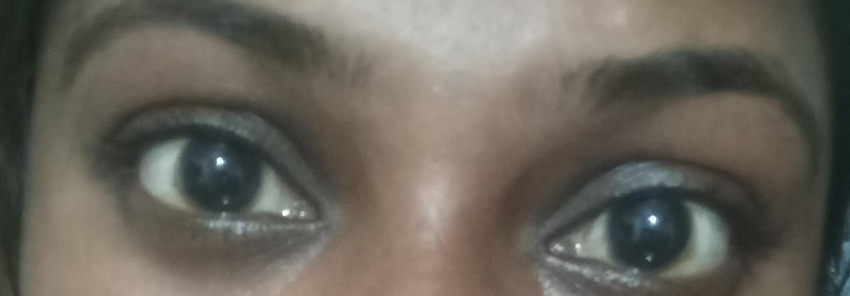 sumith_anto's tweet photo. @docakx Here another important case. She is a 27-year-old woman. She had an eye allergy in the past. Since then, her eyes have become yellowish, and it has become a chronic condition. LFT and bilirubin levels are normal. What might be the cause? Is it Pinguecula? https://t.co/d2zricIofP