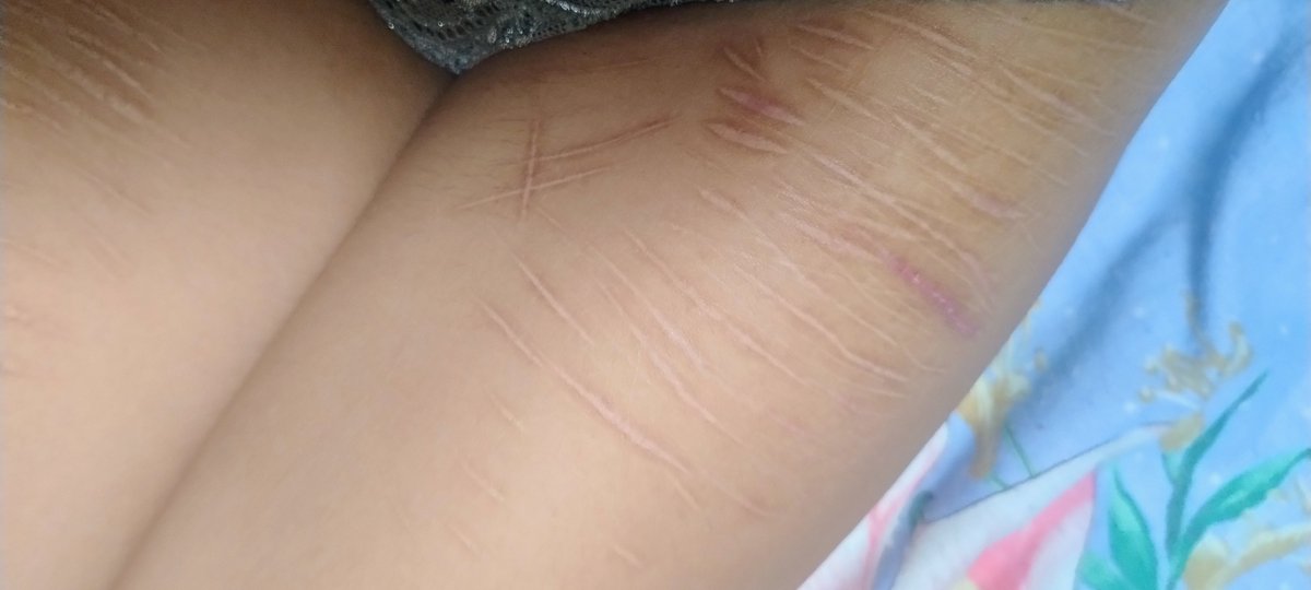 lazz_mp3's tweet photo. fotos de mis cicatrices jeje
MAQUILLAJW FALSO, NADA REAL, CONTENIDO FALSO, TRABAJO ARTÍSTICO) https://t.co/MNN4ANUhzv