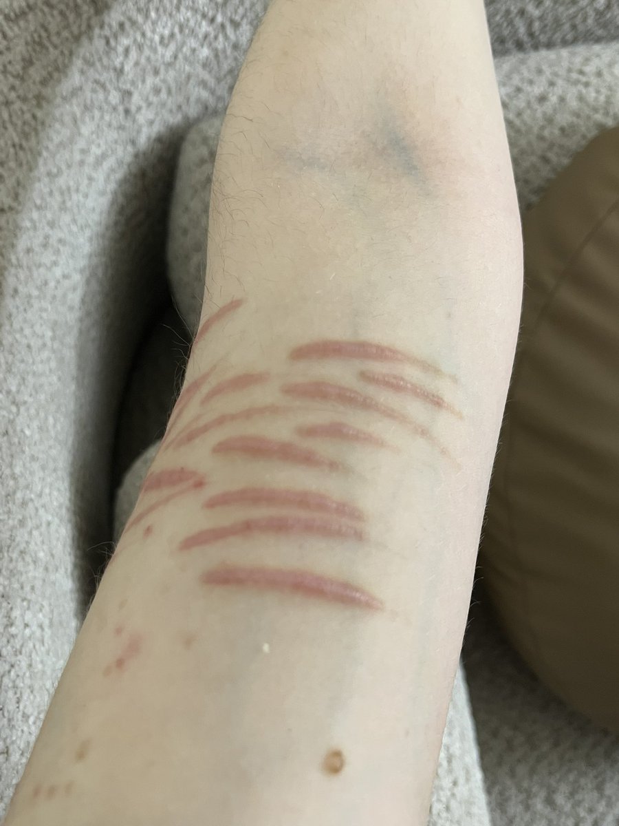 fig4ri's tweet photo. Healed left arm styros (its been like two months i think)
Cutspo anyone? https://t.co/538BFaCkeP