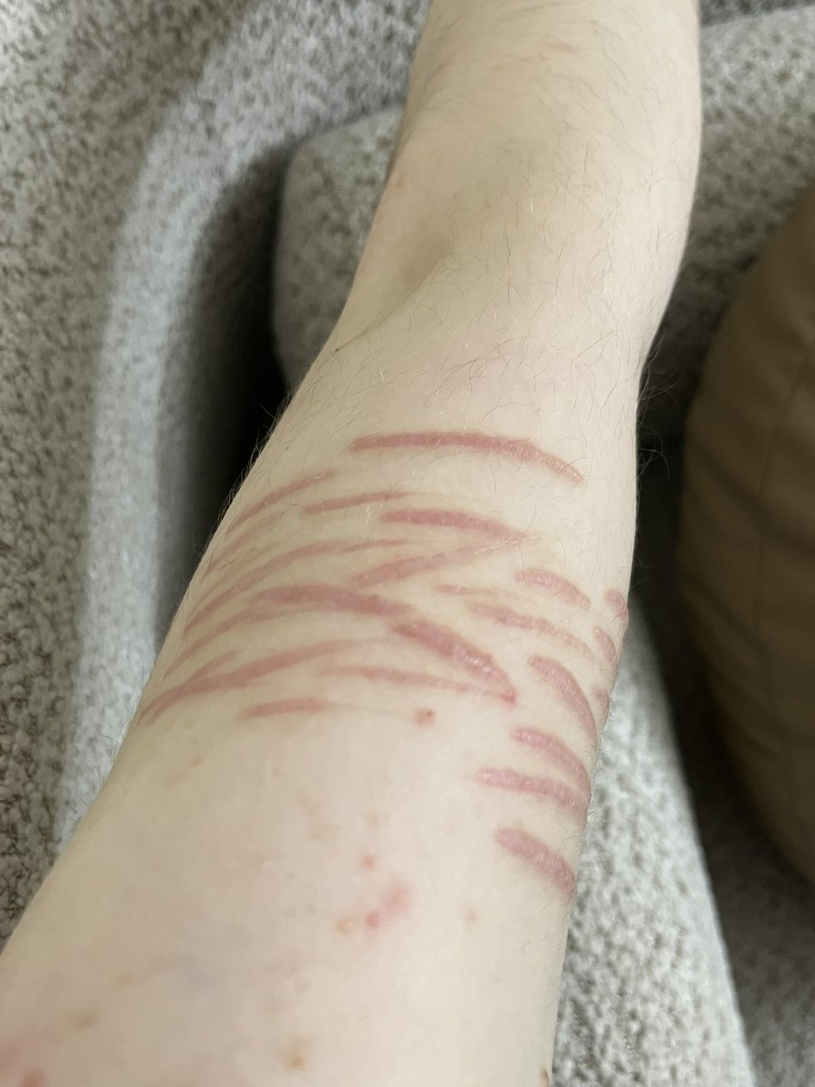 fig4ri's tweet photo. Healed left arm styros (its been like two months i think)
Cutspo anyone? https://t.co/538BFaCkeP