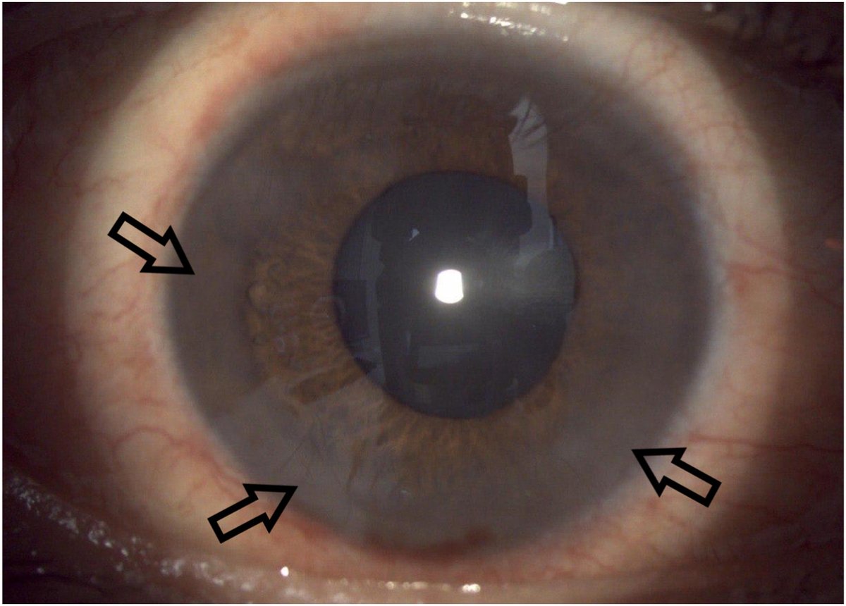 ajocasereports's tweet photo. Wessely immune rings following Keratorefractive Lenticule extraction: A case-based review https://t.co/bgaLaei4sM