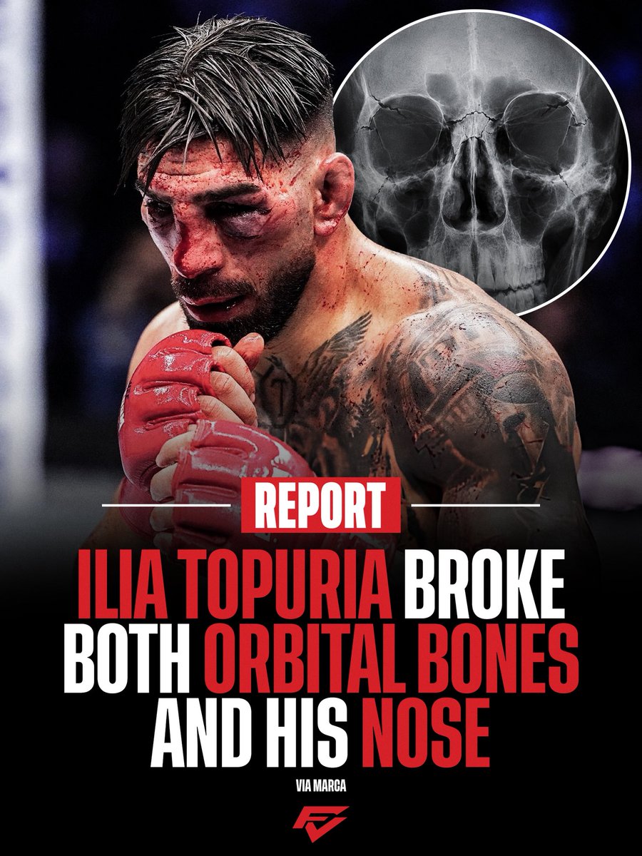 Full_Violence's tweet photo. Ilia Topuria suffered two broken orbital bones and a broken 😳

(via @marca) https://t.co/E80FmJt3yb