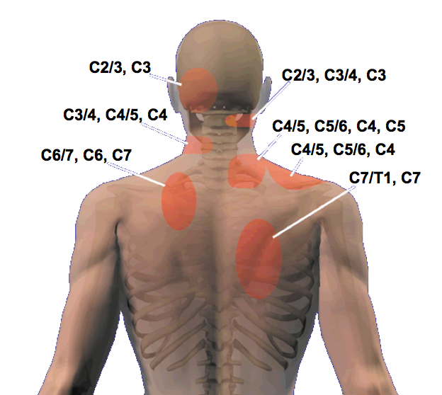 BettrHealthSol1's tweet photo. Cervical radiculopathy known as “pinched nerve” is a condition that results in radiating pain, weakness and/or numbness caused by compression of any of the nerve roots in your neck. Most cases of cervical radiculopathy go away with nonsurgical treatment. #scottsdalechiropractic https://t.co/Z4iBZYpNmd