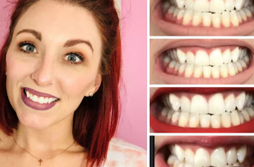 heavenbiteme's tweet photo. annoying people will post videos about their already pearly white teeth getting whitened https://t.co/83fG5qTrEL
