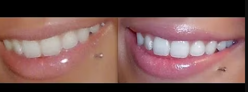 heavenbiteme's tweet photo. annoying people will post videos about their already pearly white teeth getting whitened https://t.co/83fG5qTrEL