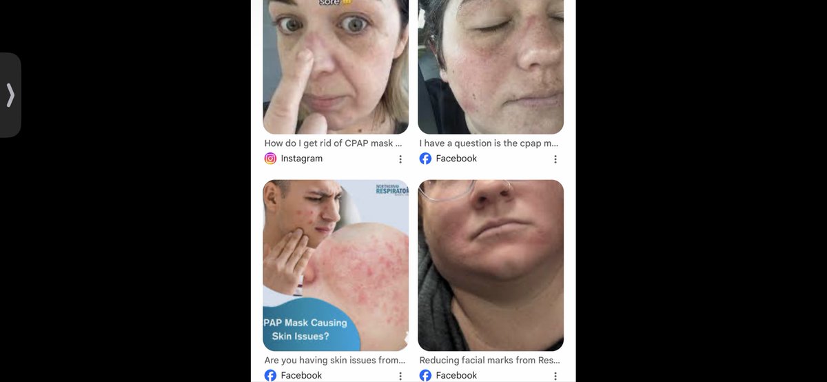 s_coy's tweet photo. @tatvonb @butterflyinth19 There’s a whole bunch of pictures of people with somewhat “permanent”  CPAP  marks on their face she says hers is a size small, which is laughable,  it’s strangling her face and looks like it’s cutting off her circulation!!!  It’s way too tight for her!! https://t.co/Czg6RfHfPQ