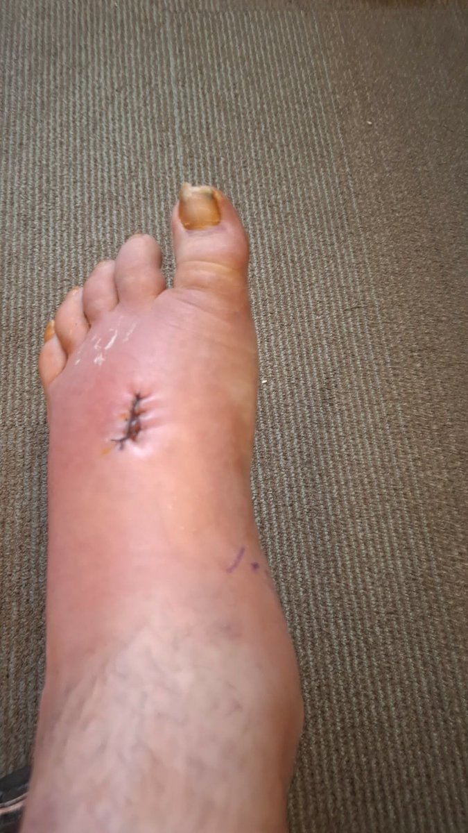 RichardDickFace's tweet photo. Just thought I'd share s few pics had surgery 2q Mondays ago finally got my cast off going into a walking boot after tearing tendons in my foot and got screws in there now to https://t.co/9MoBaJVsdH