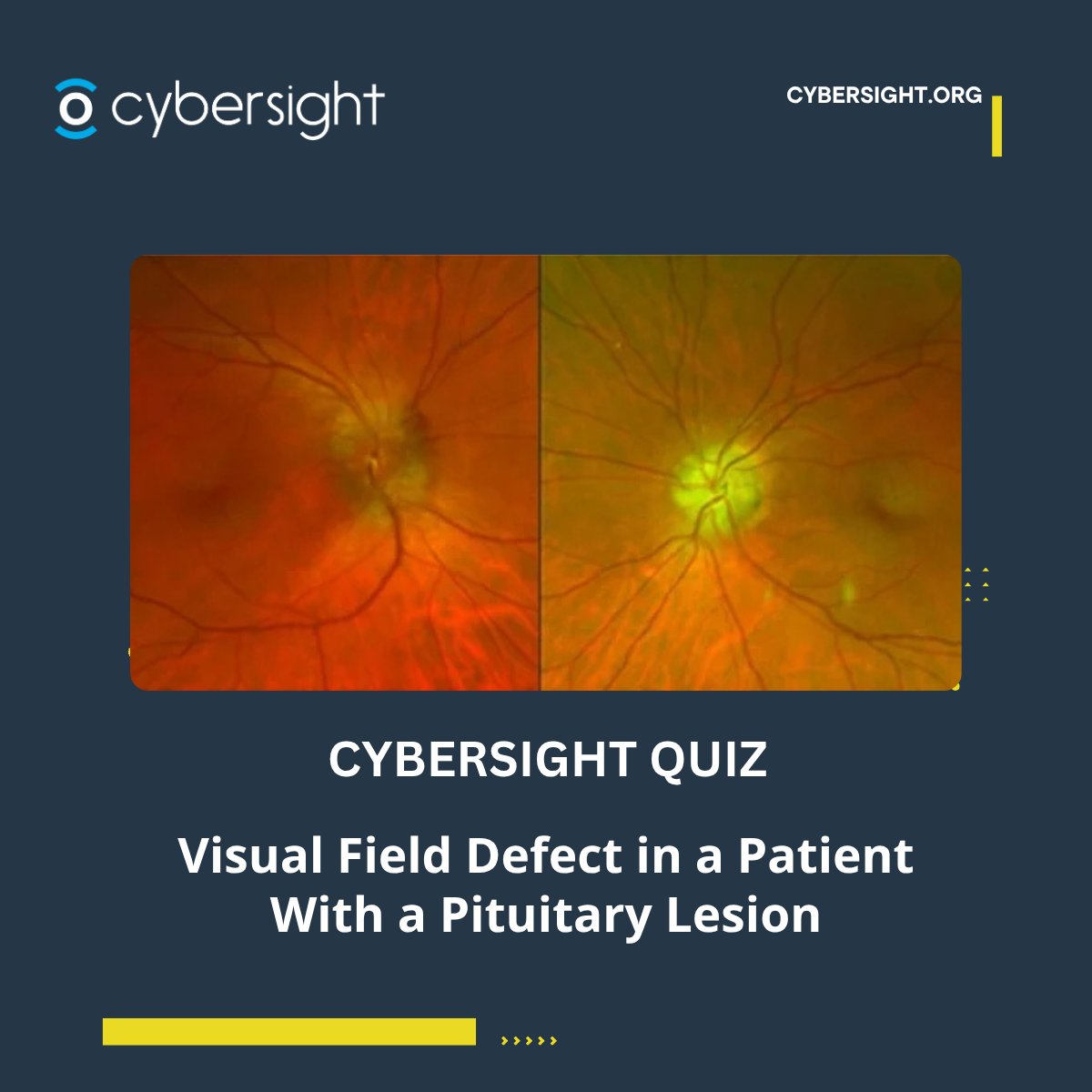 cybersight_org's tweet photo. A 51-year-old patient presents with an incidental visual field defect, with further findings including rAPD, reduced color vision, and a pituitary lesion on MRI.

An interesting neuro-ophthalmology case, many have found this both informative and challenging.

What’s your diagnosis?

Test your thinking, compare approaches with colleagues worldwide, and see how others are tackling this case.

Try the quiz on Cybersight: https://t.co/ddkg1Lf2UV

#Ophthalmology #NeuroOphthalmology #EyeHealth #ClinicalCases #MedicalEducation #Cybersight #VisualFields #Pituitary #DigitalLearning