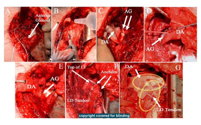 jbjs's tweet photo. "Latissimus Dorsi Transfer and Anterior Capsular Reconstruction for Subscapularis and Pectoralis Major Tears" by Zhou et al.
Read the full article π https://t.co/4cAibQM2s8
#JBJS https://t.co/zev4L3uWkf