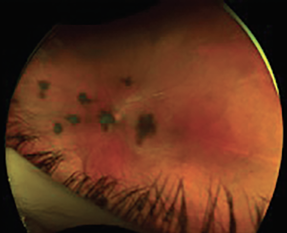 revoptom's tweet photo. Clearing the Fog: Navigating Anterior and Intermediate Uveitis

Teaching the immune system to fight back against it begins with understanding this deceptive inflammatory condition.
https://t.co/voiqtlek7Z

#optometry #uveitis #eyecare https://t.co/6aglbK5rf4