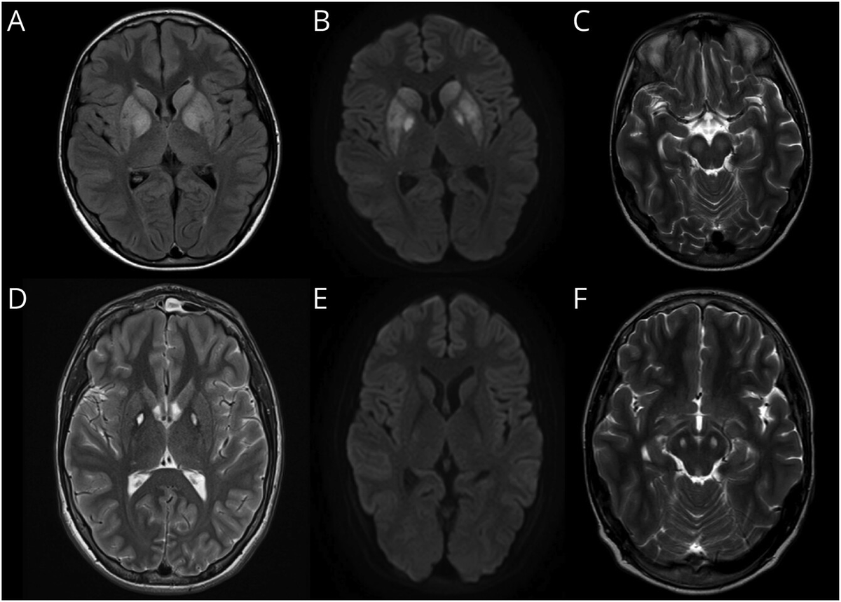 Brandon_Beaber's tweet photo. 13 year boy with slow movements, imbalance, and slurred speech after a respiratory illness.  Spinal tap was positive for anti-MOG.  Is this MOGAD?  I don't think so.  MT-ATP6 gene at 93.8% heteroplasmy levels (MT-ATP6 m.8993T > C), consistent with Leigh's https://t.co/FgJb4LZKu2 https://t.co/7knkQIh60p