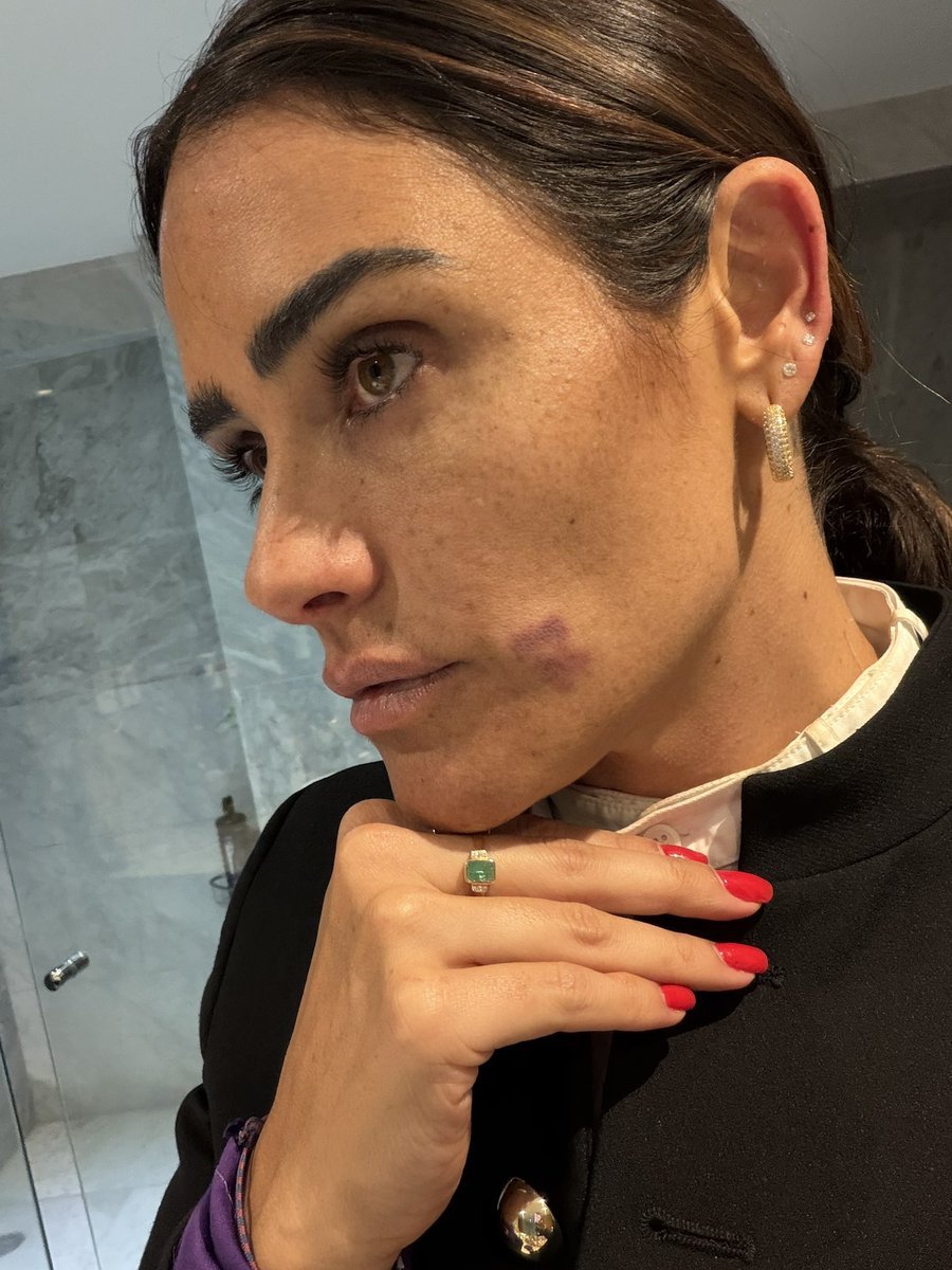 NisyMom's tweet photo. @AztecaNoticias @AlessandraRdlv POSAS UN GOLPE PARA LA FOTO?
JOYERIA, PEINADO Y ANGULO?
 ERA UNA DENUNCIA O UNA SESION PARA REVISTA????
JAMAS TENDRA EMPATIA ANTE ESE MONTAJE TAN VIL....
MEJOR MUERTA QUE SENCILLA 🤡🤡🤡
LOS HERIDOS SON LOS POLIS , NO ESA ESTÚPIDA https://t.co/ety69TaWom