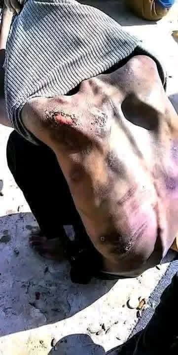 AHMED_ABUHAMAD_'s tweet photo. علامات التعذيب على جسدها ... دليلٌ لا يمكن إنكاره .

جسدها يتحدث بما أخفاه السجّان .

يتعالى التكبير في المعتقلات من شدة التعذيب .

فلا ناصر لهم إلا الله https://t.co/QSSLyhkSPD