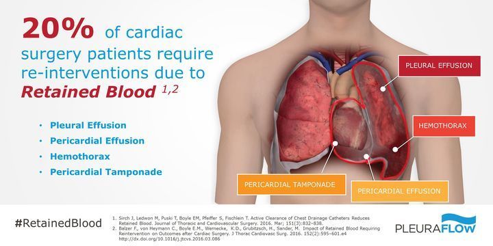 ClearFlowMed's tweet photo. Fact: Chest tubes occlude.
Fact: Occlusions cause retained blood.
Fact: Retained blood causes avoidable complications.

Solution: PleuraFlow® Active Clearance Technology®
Proactive drainage management that works.

#ClearFlow #PleuraFlow #CardiacSurgery #ERASCardiac #ICU https://t.co/Zw6qHn1D5p